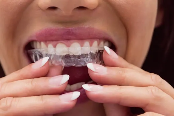 Invisalign Tacoma : Clear Aligner Therapy for Discreet Orthodontic Correction