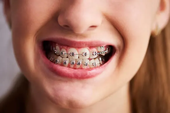 Traditional Braces: Reliable and Effective Solutions for Teeth Alignment